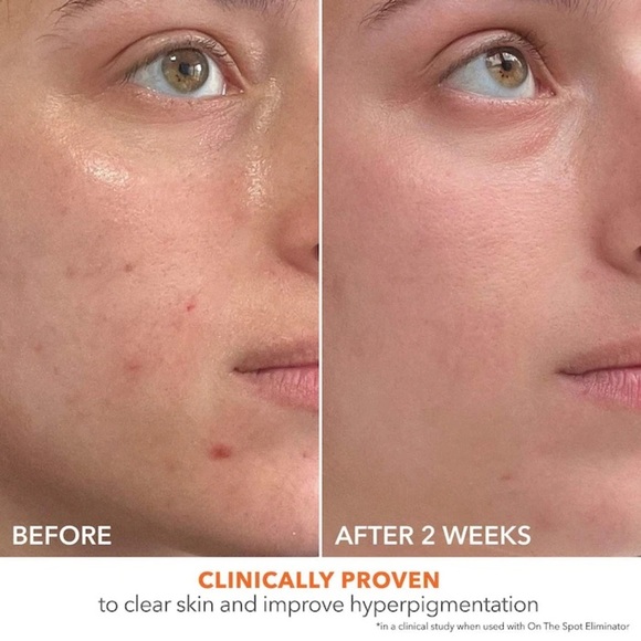 🆕 DR DENNIS GROSS Skincare Alpha Beta® 2% BHA + Breakout Solution 150 mL NWOB - Picture 7 of 13